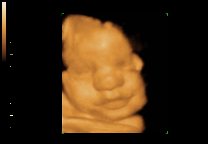 3D ultrasound image at 32 weeks